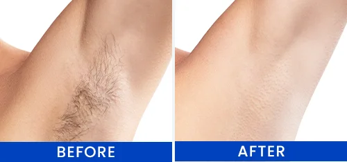 Women's Underarms Hair Removal