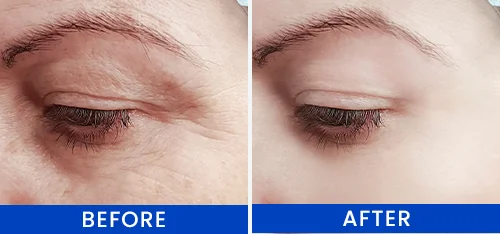 Lumi Eyes Treatment