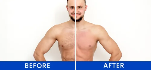 Men's Chest Laser Hair Removal